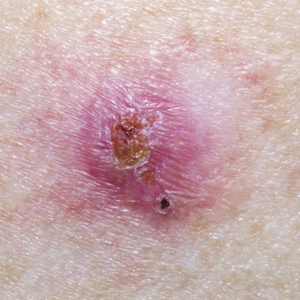 Basal Cell carcinoma