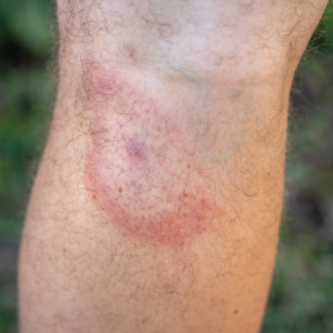 Close up of bullseye rash on arm caused by a tick bite.