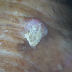 Squamous cell carcinoma